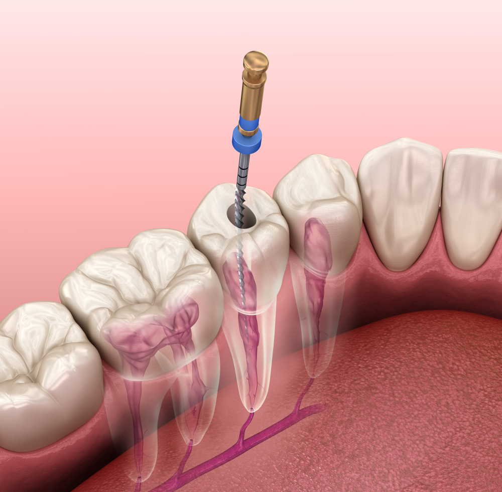 Root Canal Treatment at Everton Hills Dental Clinic